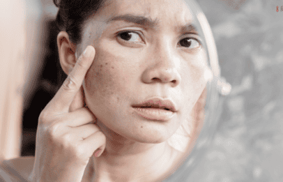 woman looking in the mirror at her melasma on her face