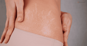 stretch marks from pregnancy
